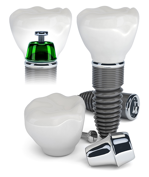 Dental Implants