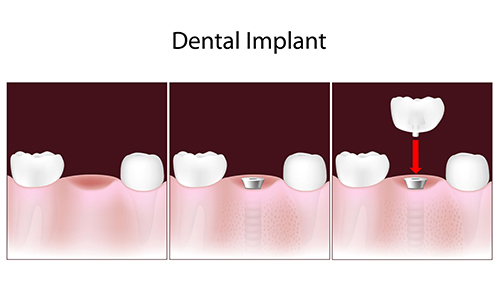 Dental Implants